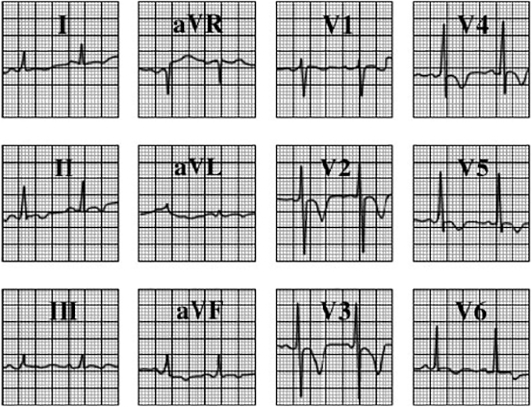 ECG answer 3