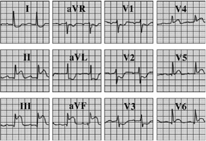 ecg