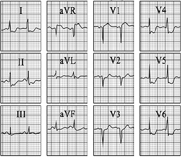 ECG answer 3