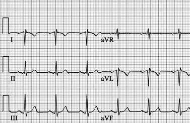 Limb lead reversal