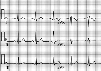 Limb lead reversal