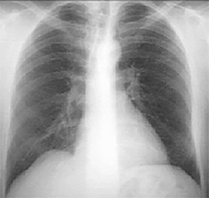 PA Xray